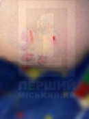 У Кривому Розі бродяча собака покусала жінку0