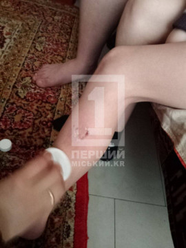 У Кривому Розі безпритульні собаки напали на 9-річного хлопчика