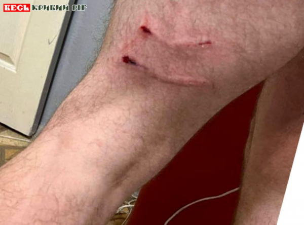 Чоловіка покусали собаки на 9 кварталі ПівнГЗК в Кривому Розі