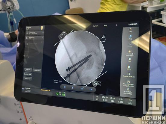 Отримав перелом, не встаючи з ліжка: 14-річний криворіжець переніс унікальну операцію у львівській лікарні