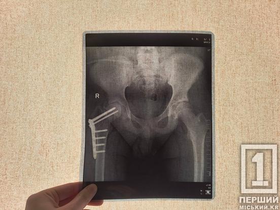 Отримав перелом, не встаючи з ліжка: 14-річний криворіжець переніс унікальну операцію у львівській лікарні